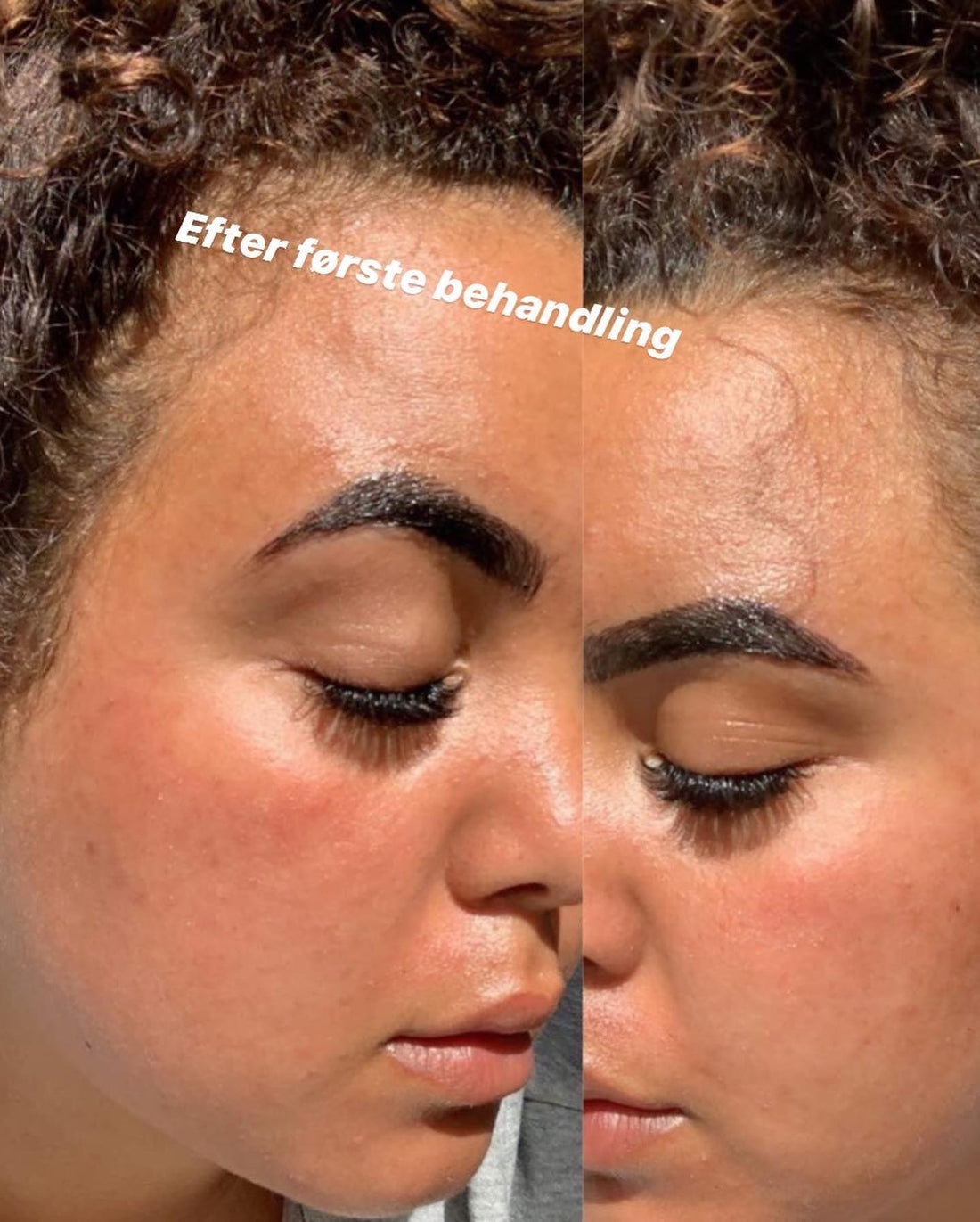 Microneedling – synlige resultater allerede efter første behandling