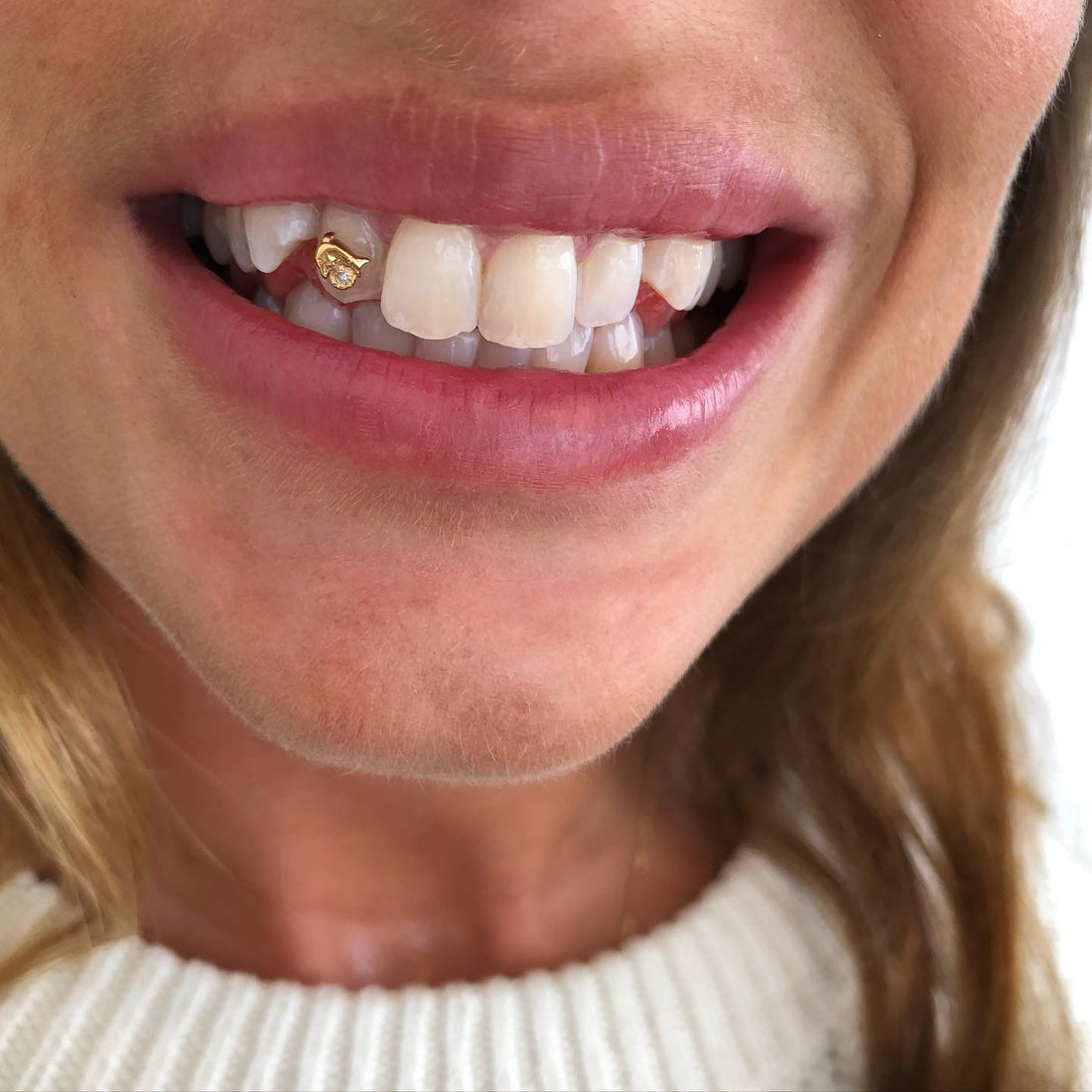 Tandblegning – op til 7 nuancer lysere smil